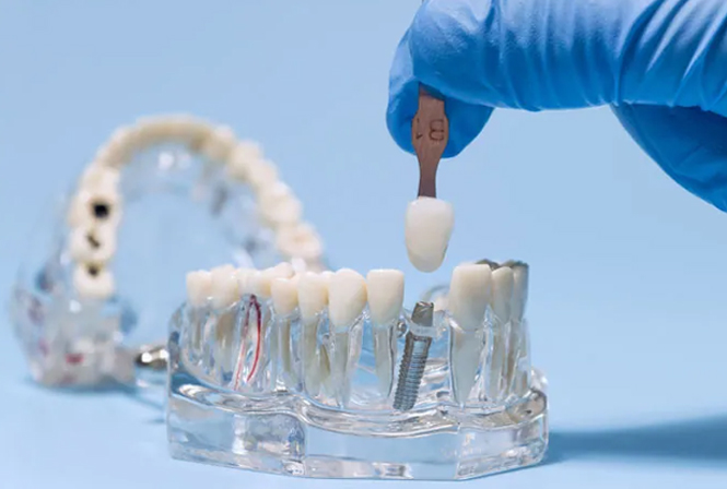Implant-Related Materials